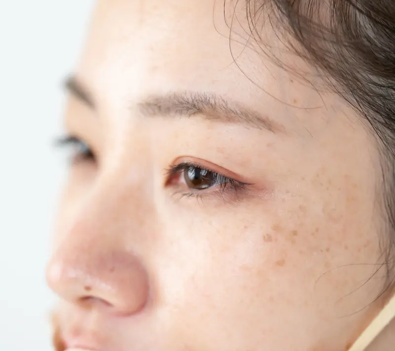 シミ・肝斑・くすみのイメージ